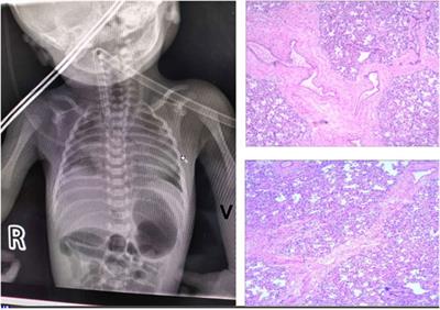 A Frameshift RBM10 Variant Associated With TARP Syndrome